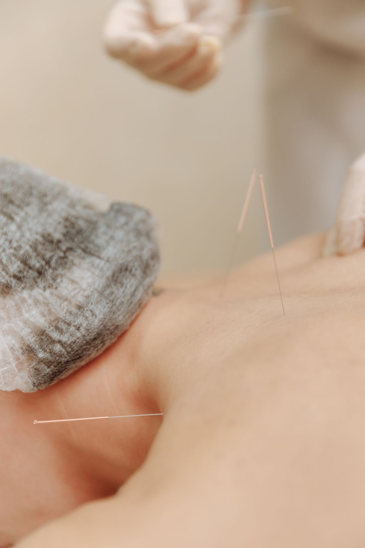 Acupuncture